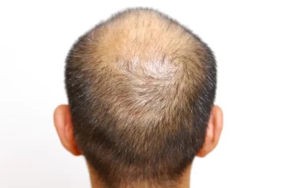 【速報】『ハゲ』←放送禁止用語へｗｗｗｗｗｗ