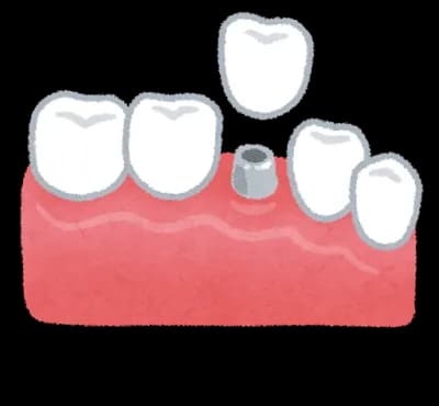 インプラント🦷ってどうなんや