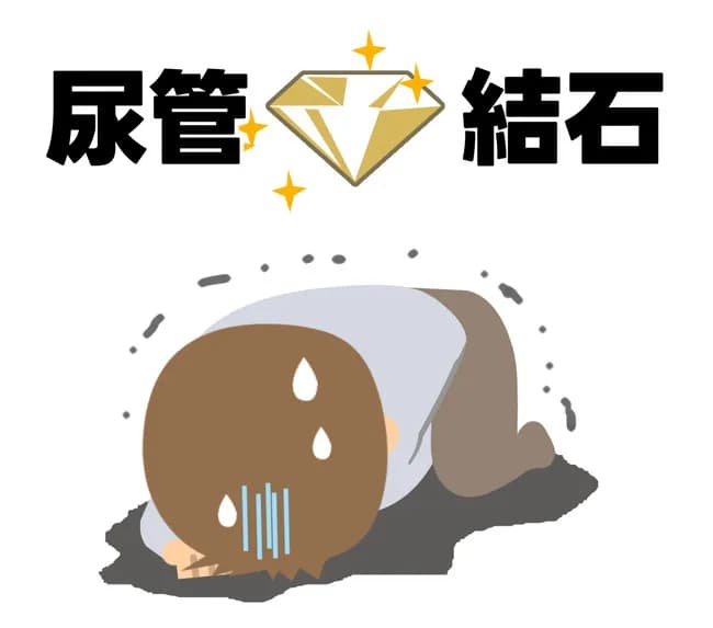 尿管結石のかっこいい呼び方