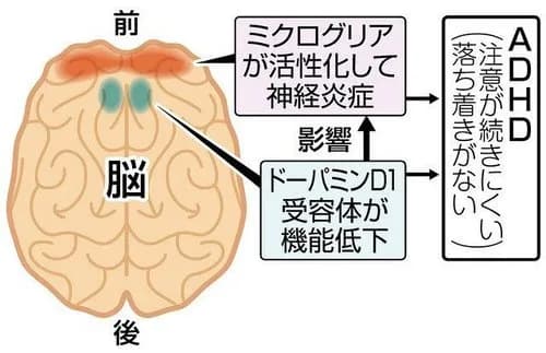 【悲報】「ASD」「ADHD」「不安障害」「双極性障害」←この中に1つだけガチで救いがない障害が混じってるｗｗｗｗｗｗｗｗｗｗ