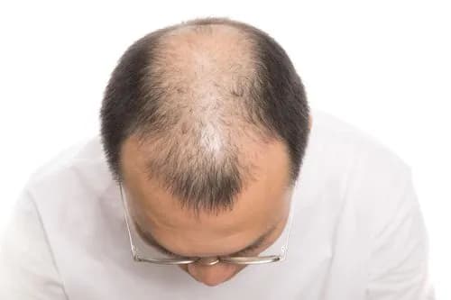 【爆笑】歌詞の「君」を「髪」に変えるとガチでハゲへの応援歌になるｗｗｗｗｗｗｗｗｗｗ