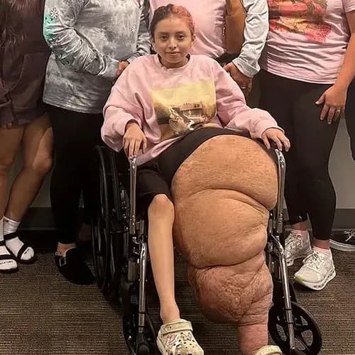 【衝撃】14歳のアメリカ人少女さん、手術で約80kgの「減量」に成功・・・・・・・・・