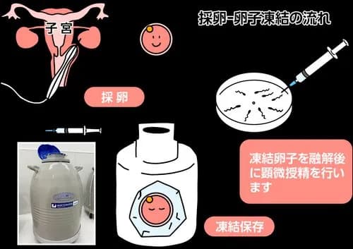 【悲報】国さん、未婚女性の卵子凍結補助を35歳までに制限してしまう・・・・・・・・・
