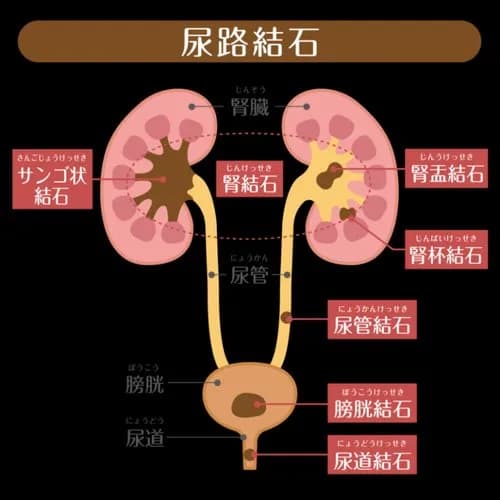 【悲報】尿管結石経験者さん、それよりきつかった痛みを挙げてけｗｗｗｗｗｗｗｗｗｗ