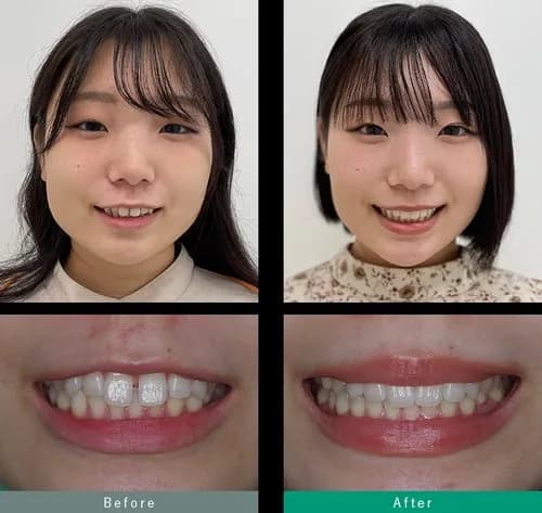 【悲報】日本人さんの歯、ガチで汚すぎるｗｗｗｗｗｗｗｗｗｗ