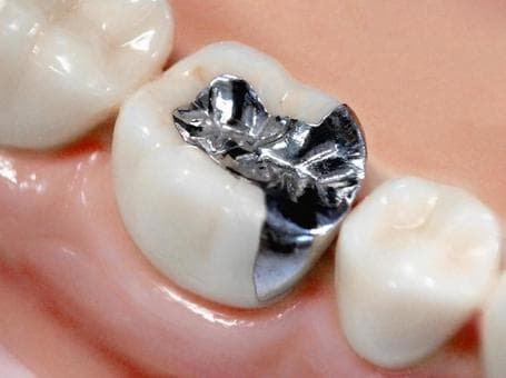 【悲報】銀歯が臭すぎるｗｗｗｗｗｗｗｗｗｗｗｗｗｗｗｗ