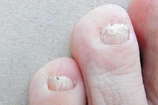 【悲報】爪水虫、罹ったら終わりwwwwwwwwwwwwwwww