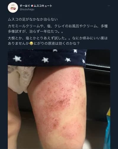 【悲報】自然派ママさん「助けて!息子の足が治らないの😭あらゆることを試したのに…」wwwwwwwwww